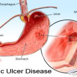 peptic ulcer disease definition -medicaltone