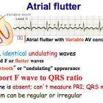 Atrial fibrillation vs Atrial Flutter