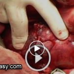 How to Remove Renal Stones (Kidney Stones)
