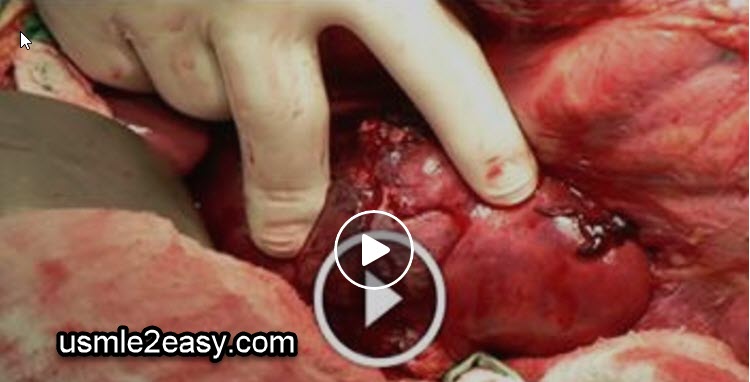 How to Remove Renal Stones (Kidney Stones)