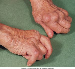 Rheumatoid arthritis>> Rheumatoid factor (IgM against IgG Fc region) Anti-CCP (more specific)